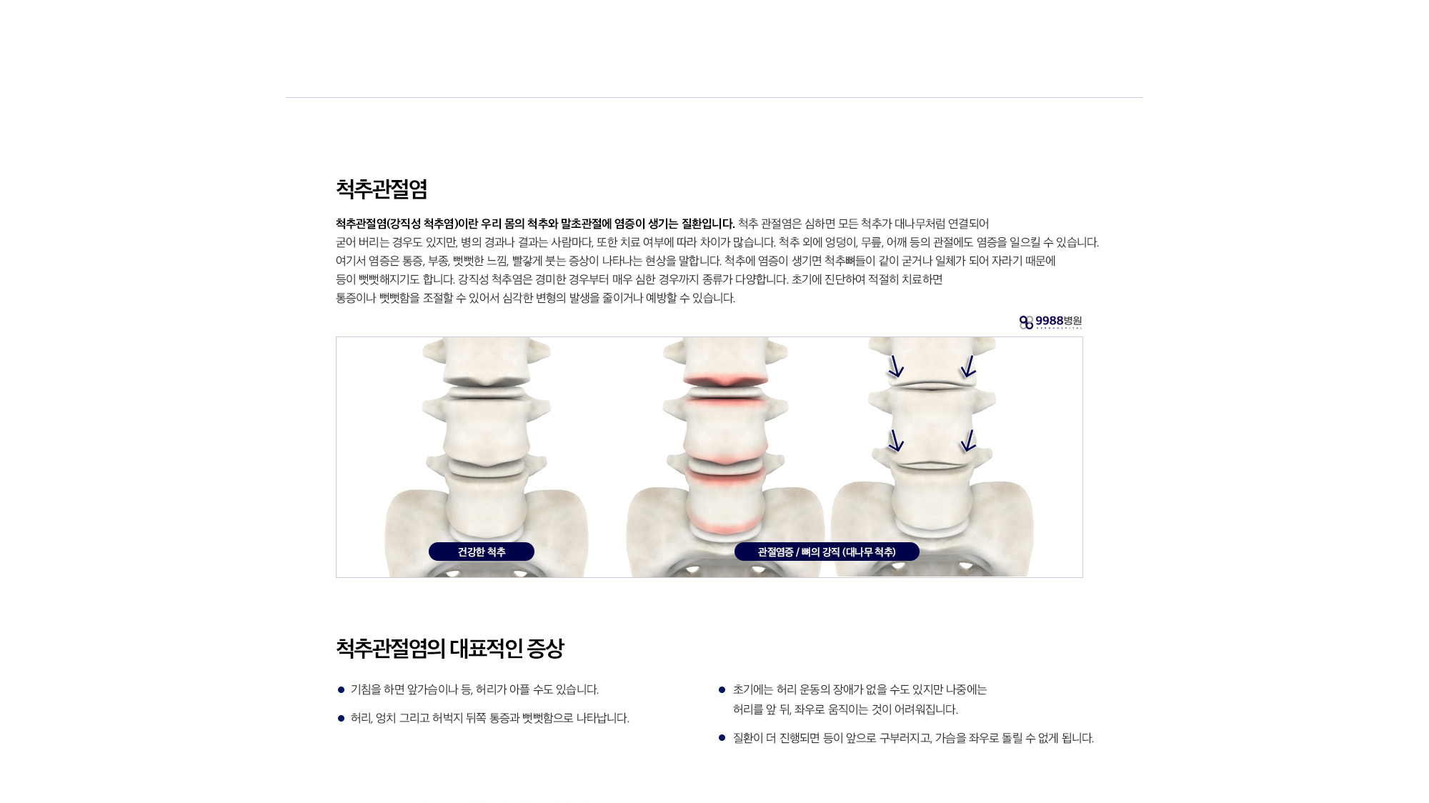 척추관절염