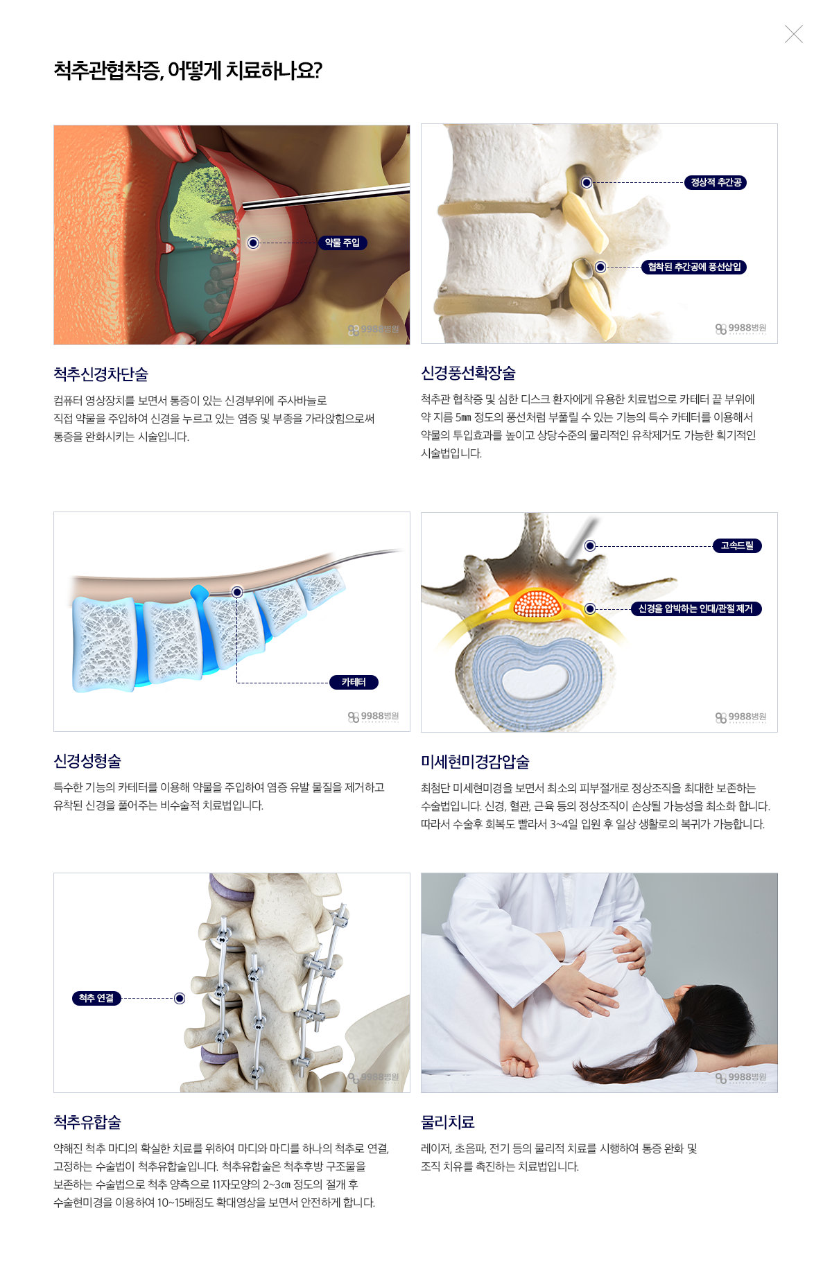 척추관협착증