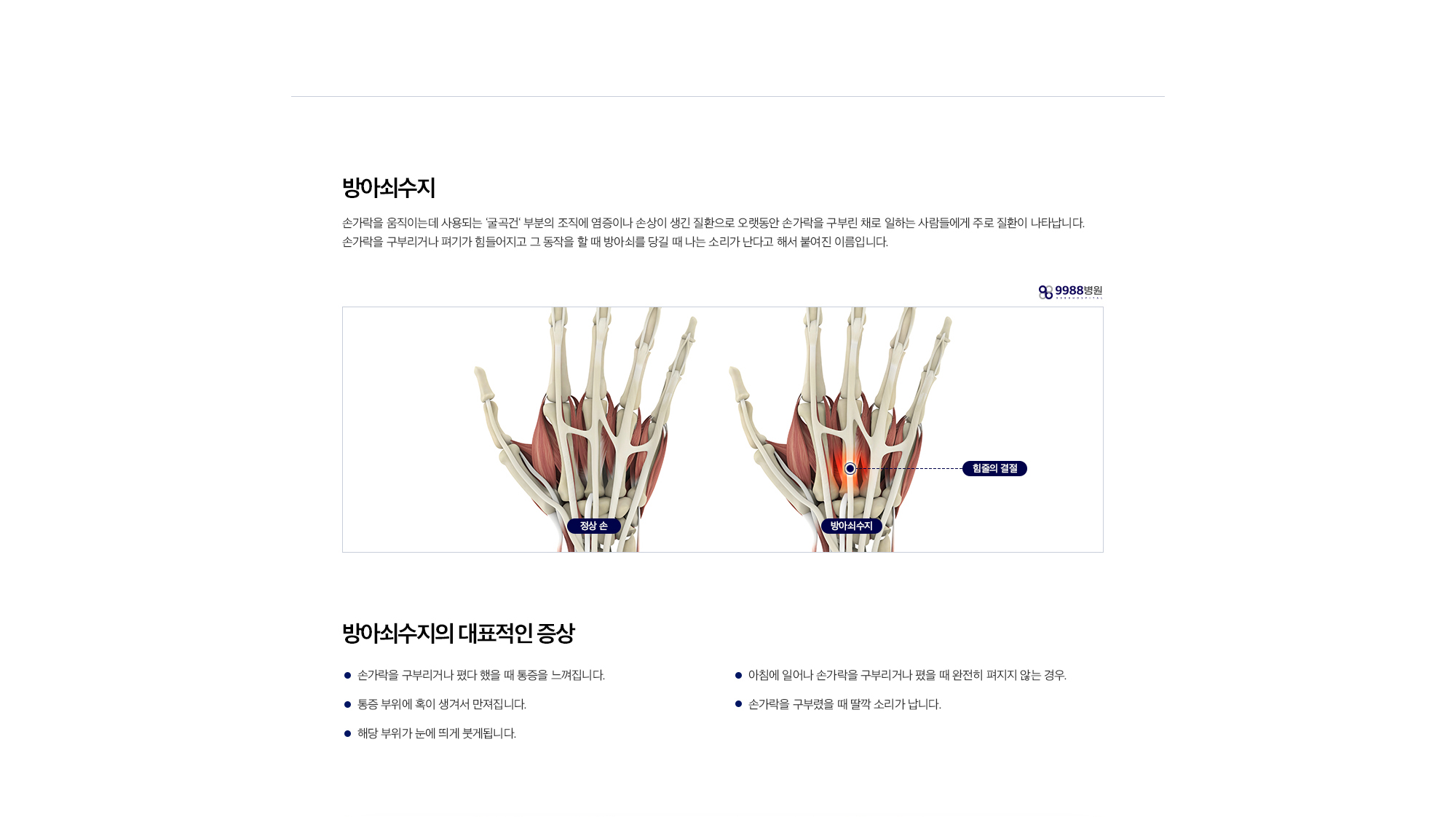 방아쇠수지