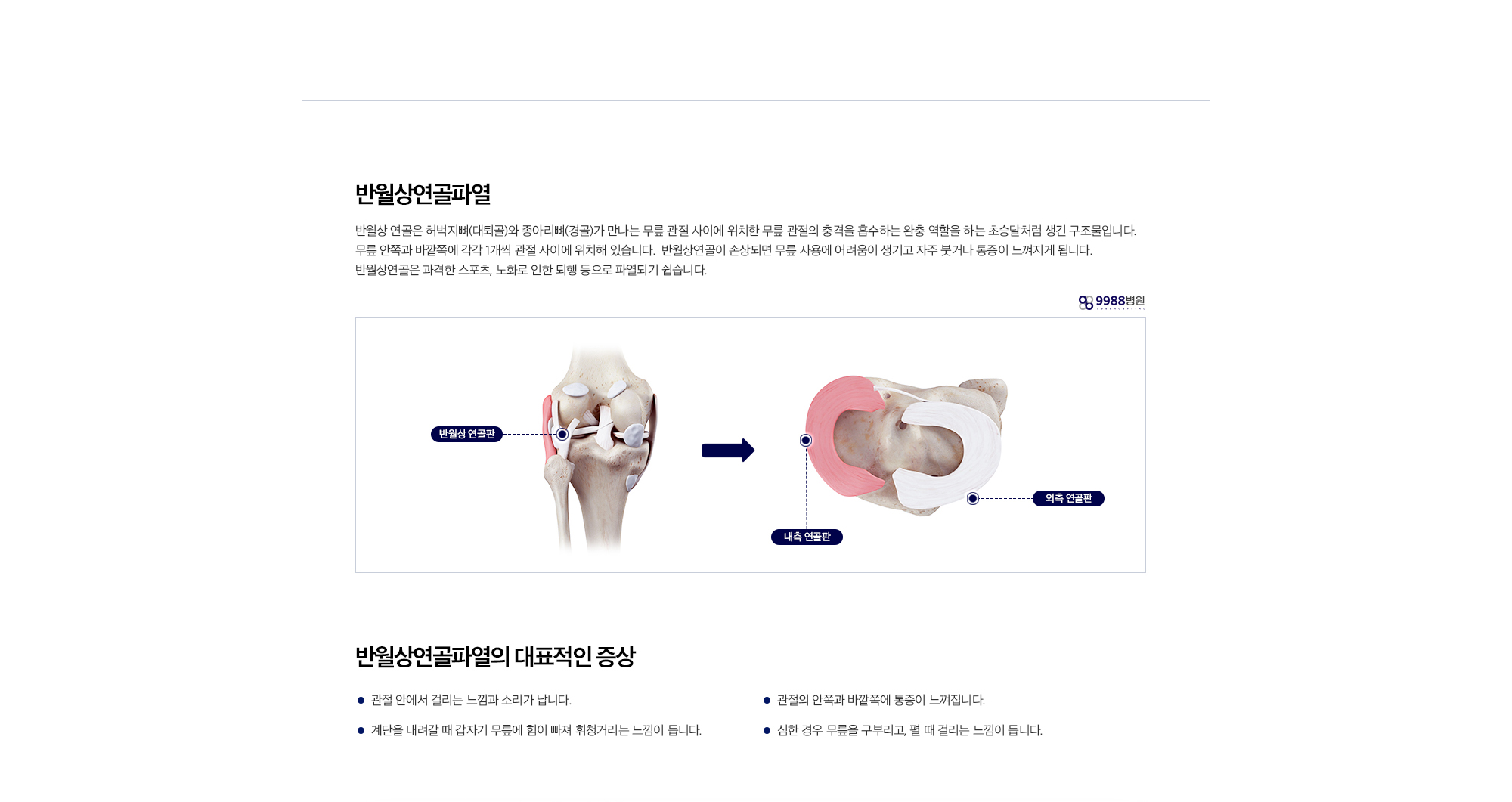 반월상연골파열