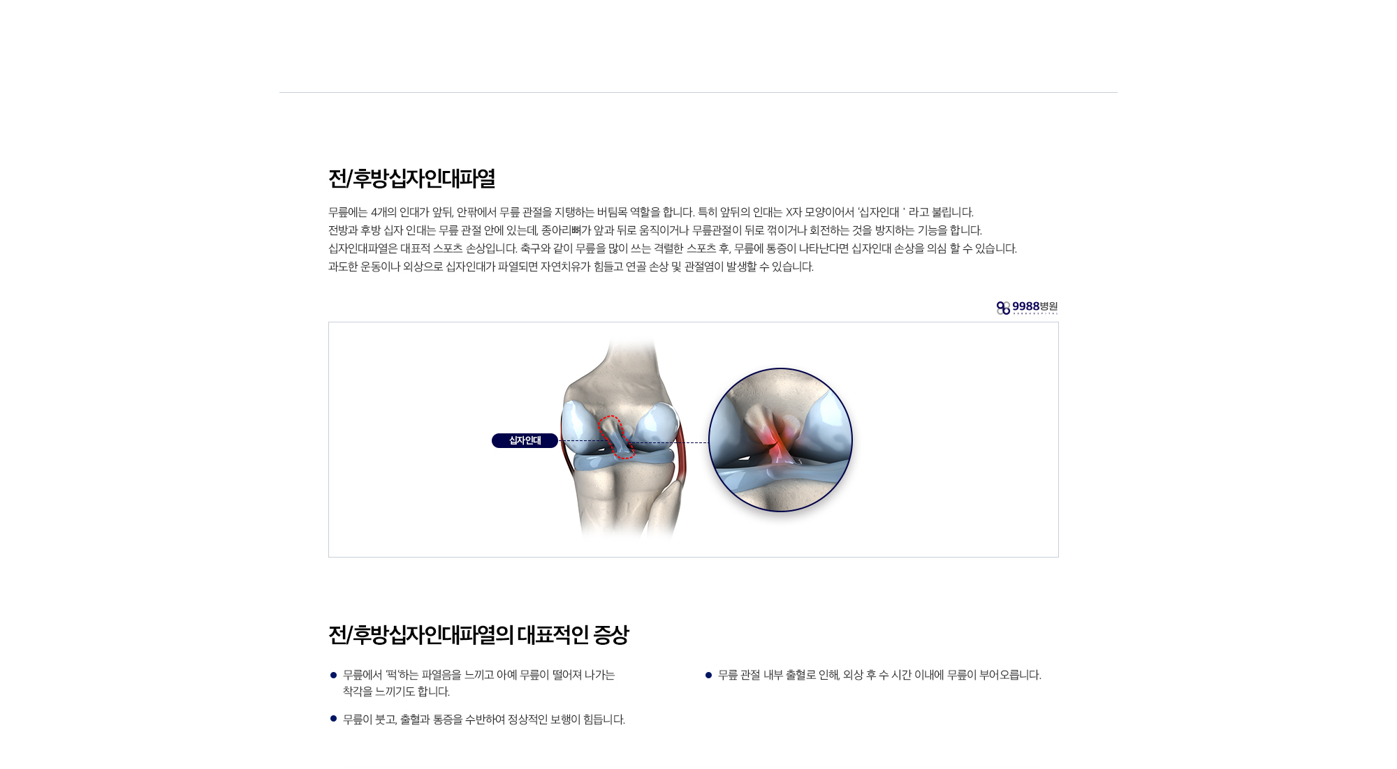 전/후방 십자인대파열