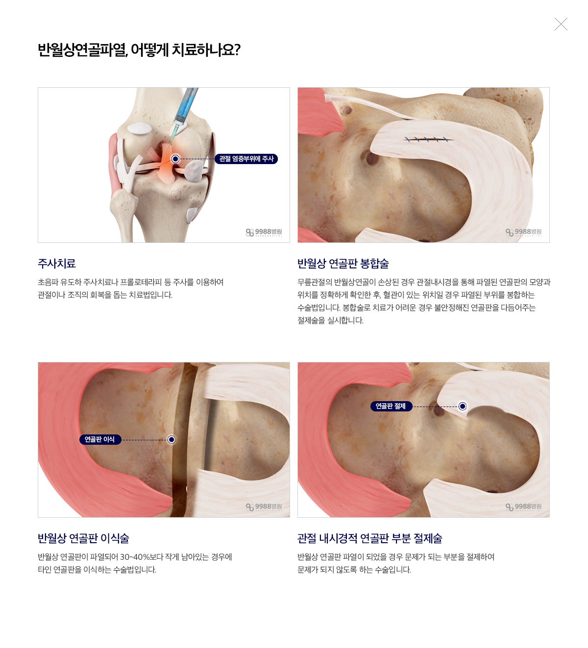 반월상연골파열