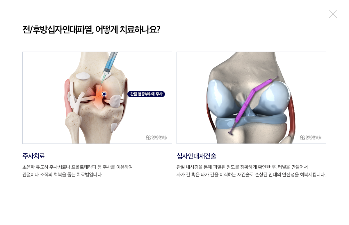 전/후방 십자인대파열