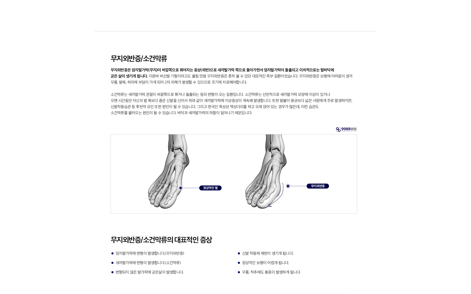 무지외반증/소건막류